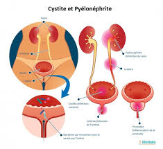 Infection urinaire cystite