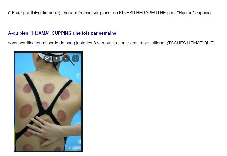 Ordonnance pour cupping - indications et protocole